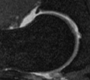 Impingement-Syndrom der Hüfte - MVZ Wiesbaden